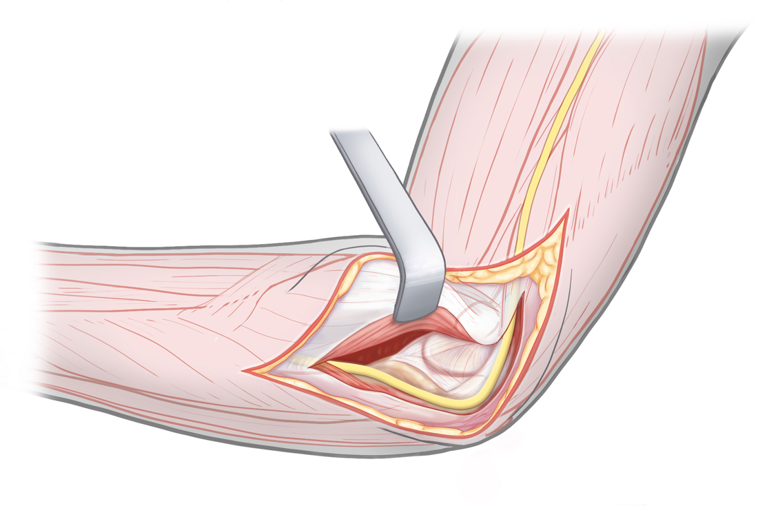 Medial surgical approach to elbow