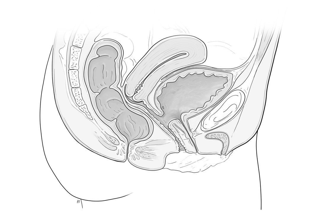 Vesicovaginal fistual