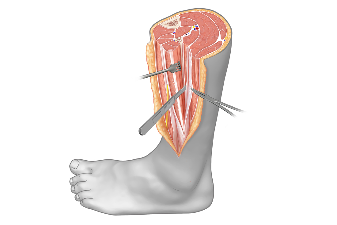 Fasciotomy of the lower leg