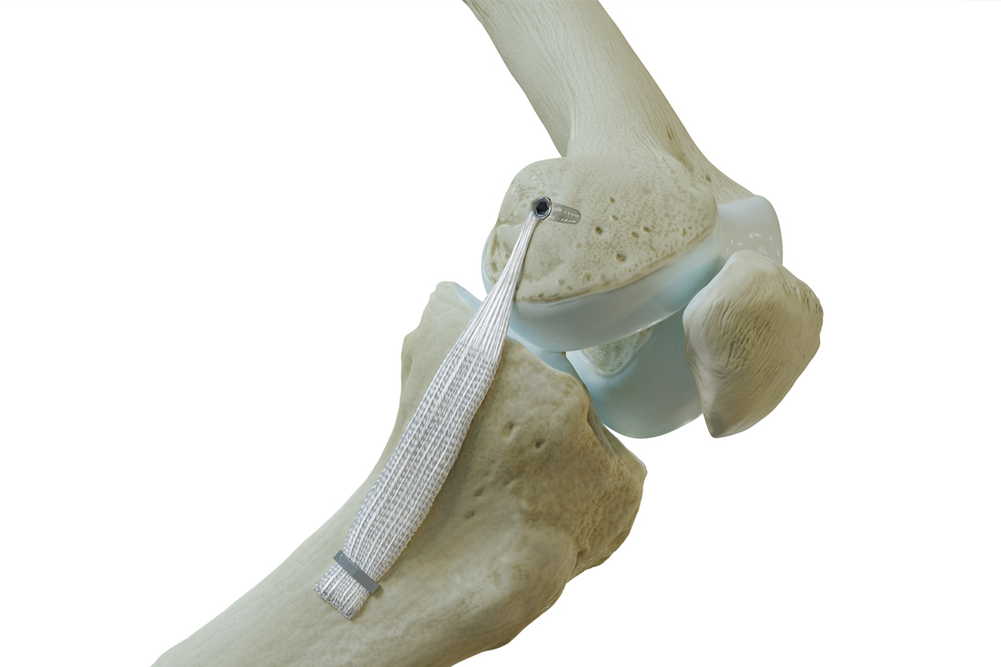 Medial collateral ligament repair