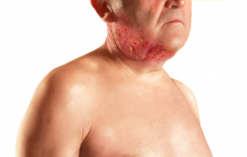 Stage 3 Radiation burn from cancer treatment
