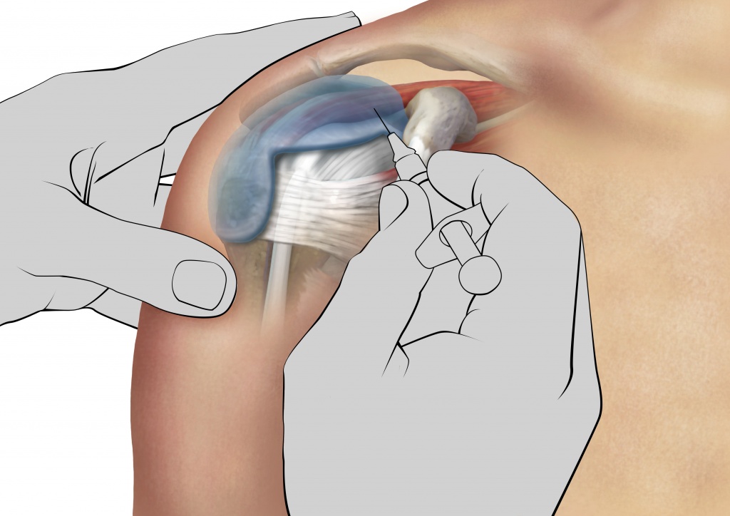 Subacromial Inj Shoulder Subacromial Injection Anterior Approach Youtube